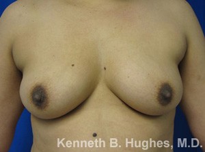 Breast Augmentation (Implants)