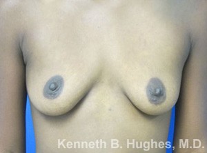 Breast Augmentation (Implants)