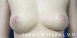 Breast Augmentation (Implants)