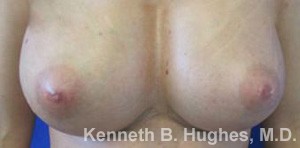 Breast Augmentation (Implants)