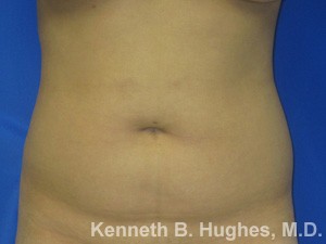 Liposuction