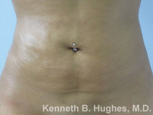 Liposuction