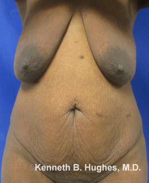 Breast Augmentation and Lift