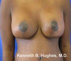 Breast Augmentation and Lift