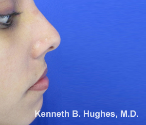 Rhinoplasty