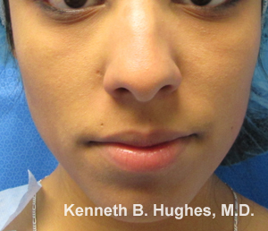 Rhinoplasty