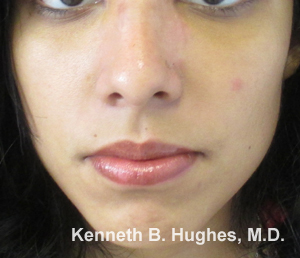 Rhinoplasty