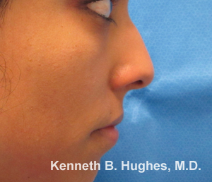 Rhinoplasty
