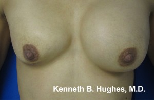 Breast Augmentation (Implants)