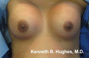 Breast Augmentation (Implants)