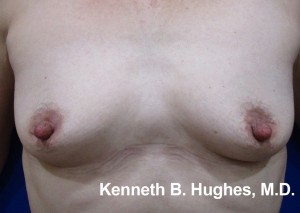 Breast Augmentation (Implants)