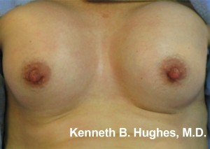 Breast Augmentation (Implants)