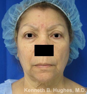 Eyelid Surgery