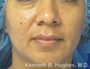 Eyelid Surgery
