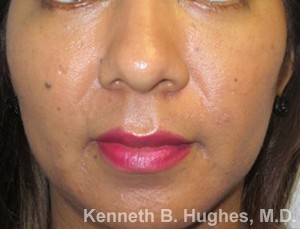 Eyelid Surgery