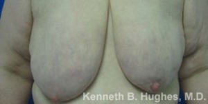 Breast Augmentation and Lift