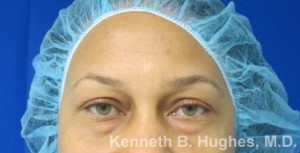 Eyelid Surgery