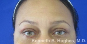 Eyelid Surgery