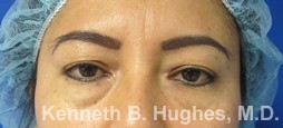 Eyelid Surgery