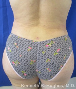 Brazilian Butt Lift