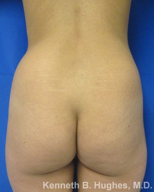 Brazilian Butt Lift