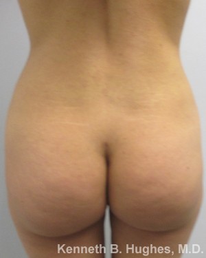 Brazilian Butt Lift