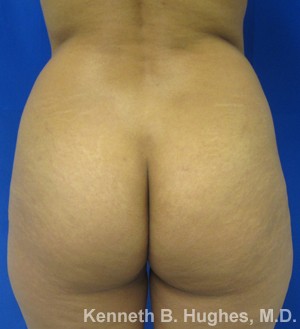 Brazilian Butt Lift