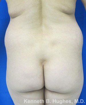 Brazilian Butt Lift