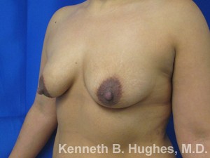 Breast Augmentation and Lift