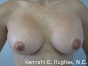 Breast Augmentation (Implants)