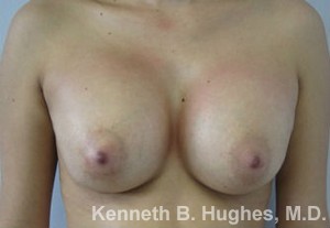 Breast Augmentation (Implants)