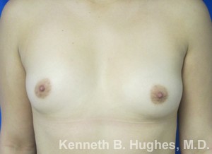 Breast Augmentation (Implants)
