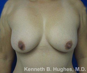 Breast Augmentation (Implants)