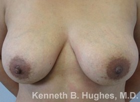 Breast Augmentation (Implants)