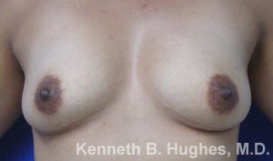 Breast Augmentation (Implants)