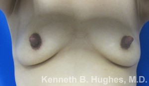 Breast Augmentation (Implants)