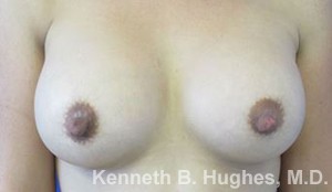 Breast Augmentation (Implants)