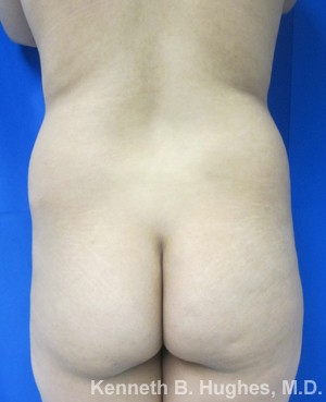 Liposuction