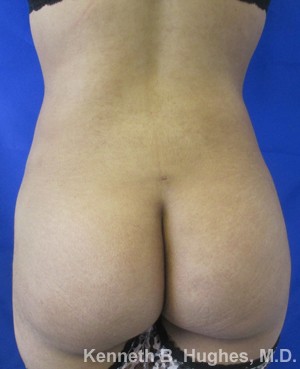 Liposuction