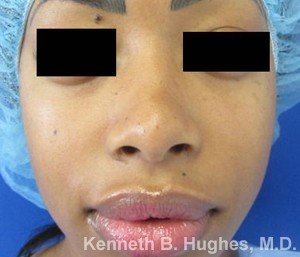 Rhinoplasty