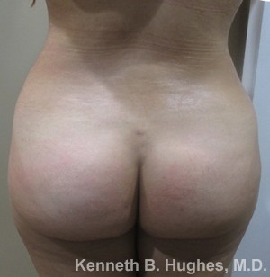 Brazilian Butt Lift