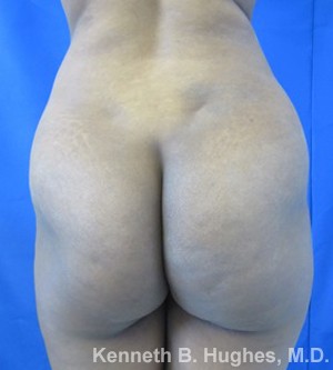 Brazilian Butt Lift
