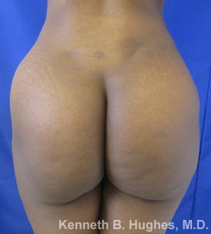 Brazilian Butt Lift