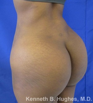 Brazilian Butt Lift