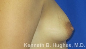 Breast Augmentation (Implants)