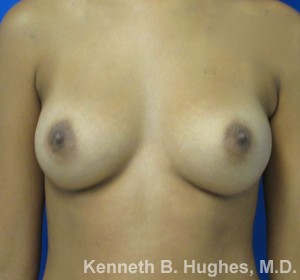 Breast Augmentation (Implants)