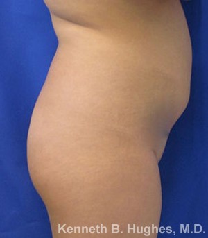 Butt Implants