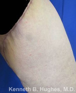 Thigh Lift