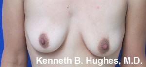 Breast Augmentation (Implants)