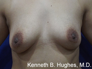Breast Augmentation (Implants)